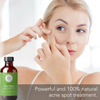 A person is applying Tea Tree Essential Oil, 4 fl oz to their face. A bottle labeled "Tea Tree Essential Oil, 4 fl oz" is shown on the left side of the image. There is text at the bottom of the image that reads, "Powerful and 100% natural acne spot treatment.