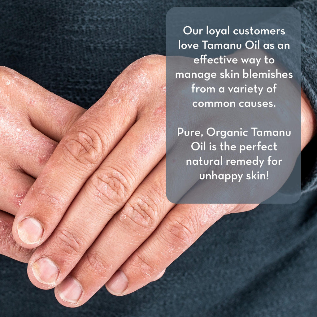 Close-up of hands with visible skin blemishes and redness. Text overlay reads: "Our loyal customers love Cold Pressed Tamanu Oil as an effective way to manage skin blemishes from a variety of common causes. Pure, Organic Cold Pressed Tamanu Oil is the perfect natural remedy for unhappy skin!